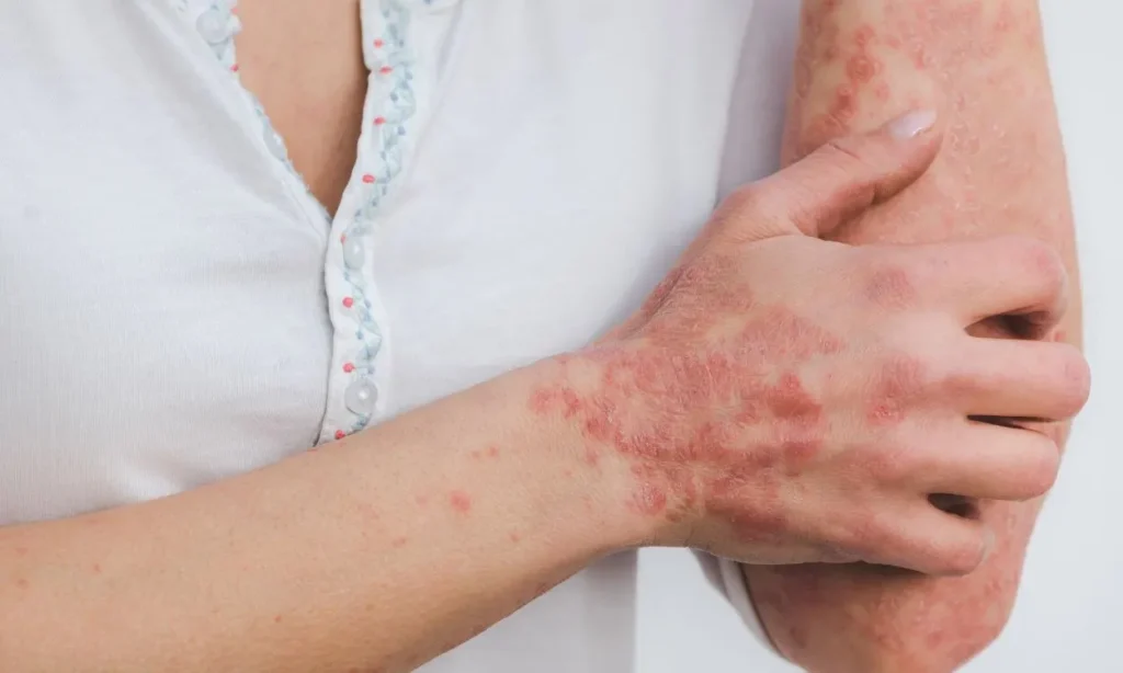 A Psoríase e Yoga 2 psoriase-e-yoga-tipos